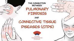 An explainer video that makes the connection between pulmonary fibrosis and connective tissue diseases